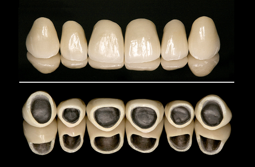 Răng sứ kim loại 