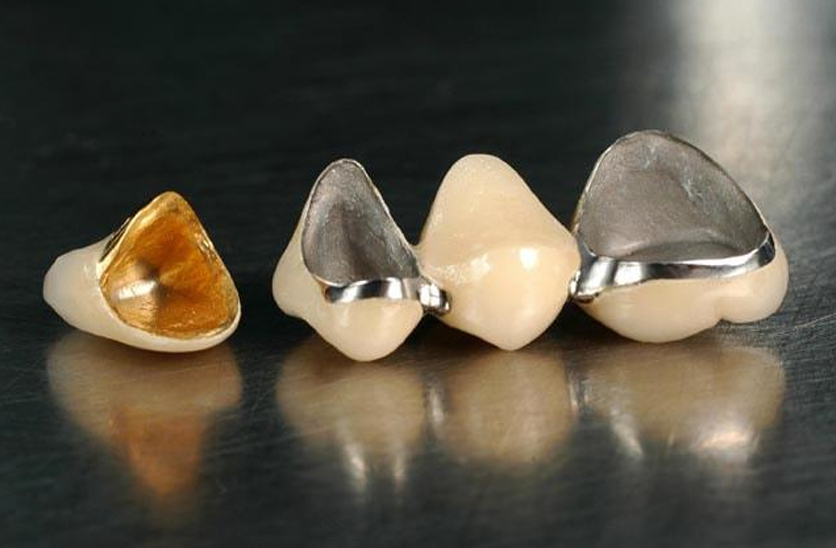 Răng sứ kim loại 