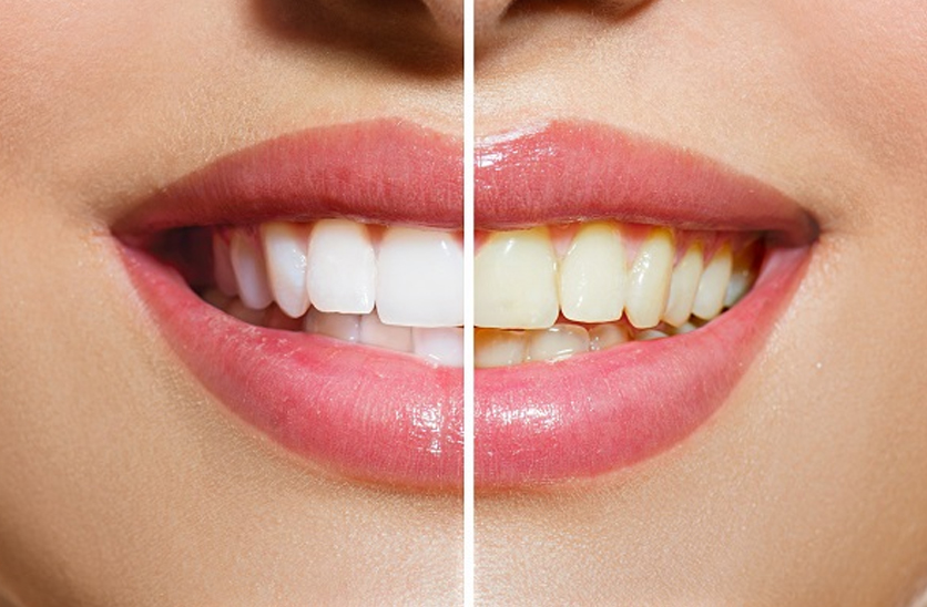 Răng sứ kim loại 