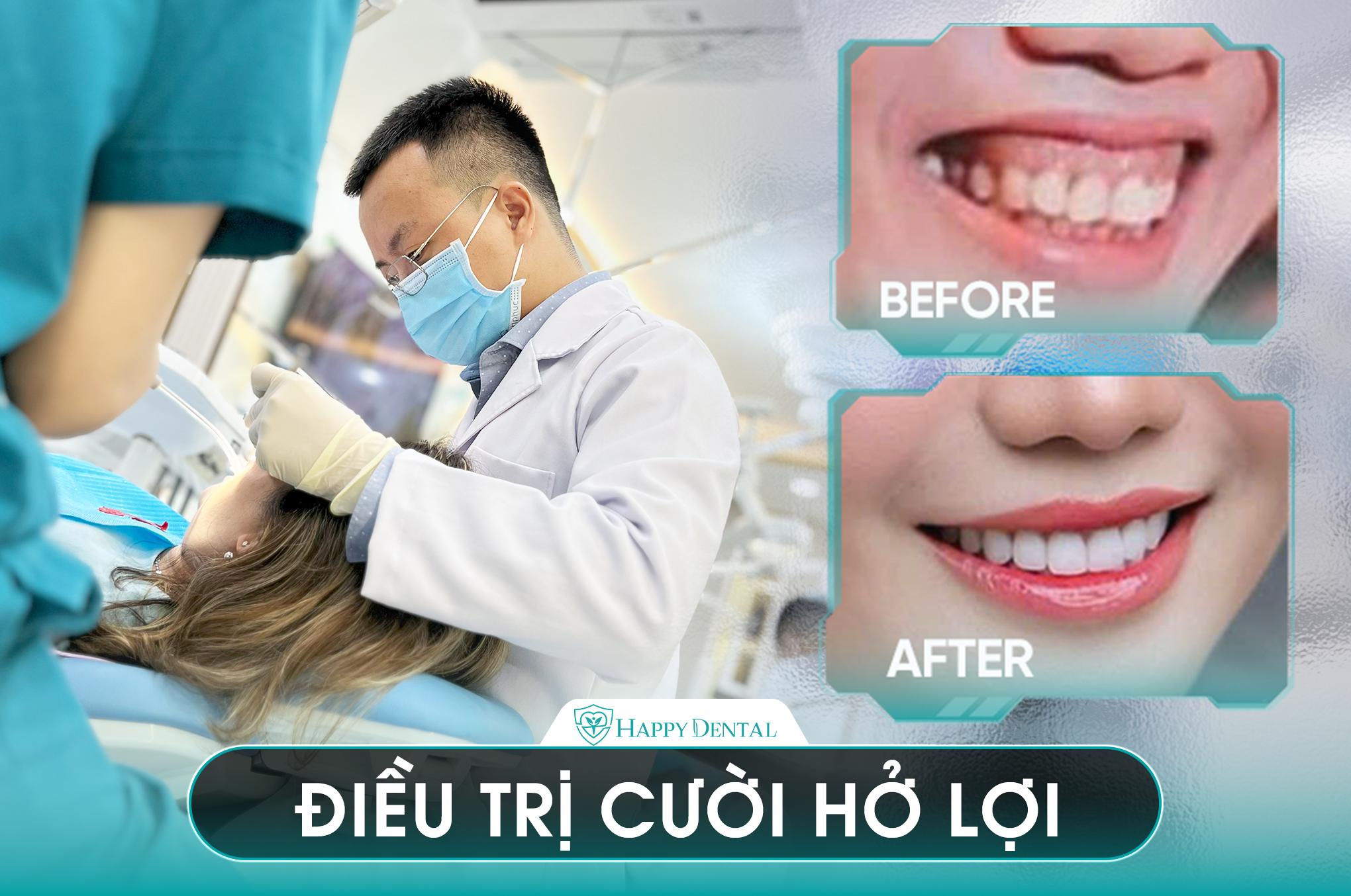 KHÁCH HÀNG ĐIỀU TRỊ CƯỜI HỞ LỢI TẠI HAPPY DENTAL
