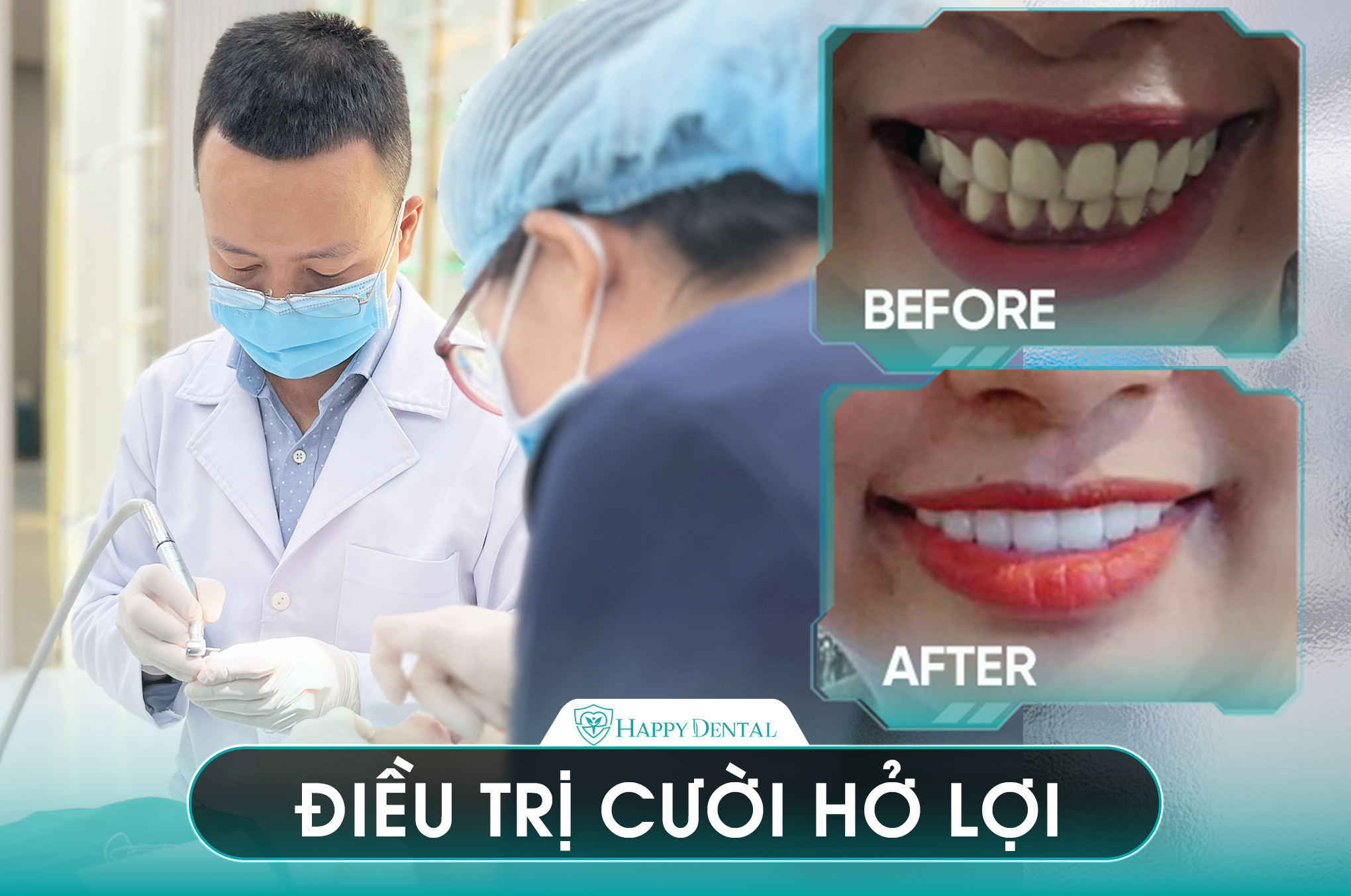 Hình ảnh điều trị cười hở lợi cho khách hàng tại Happy Dental