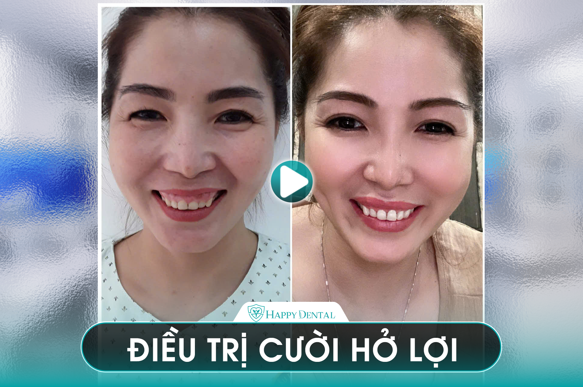 KHÁCH HÀNG ĐIỀU TRỊ CƯỜI HỞ LỢI TRỰC TIẾP TẠI HAPPY DENTAL