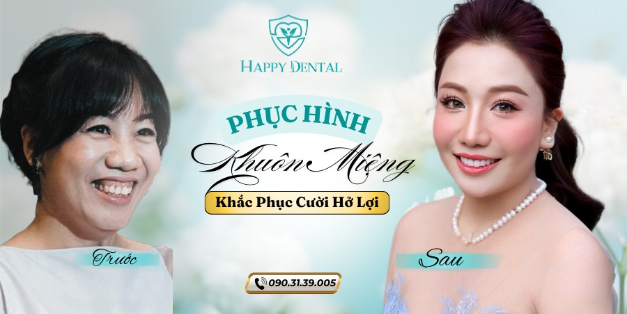 Kết quả điều trị cười hở lợi tại Happy Dental