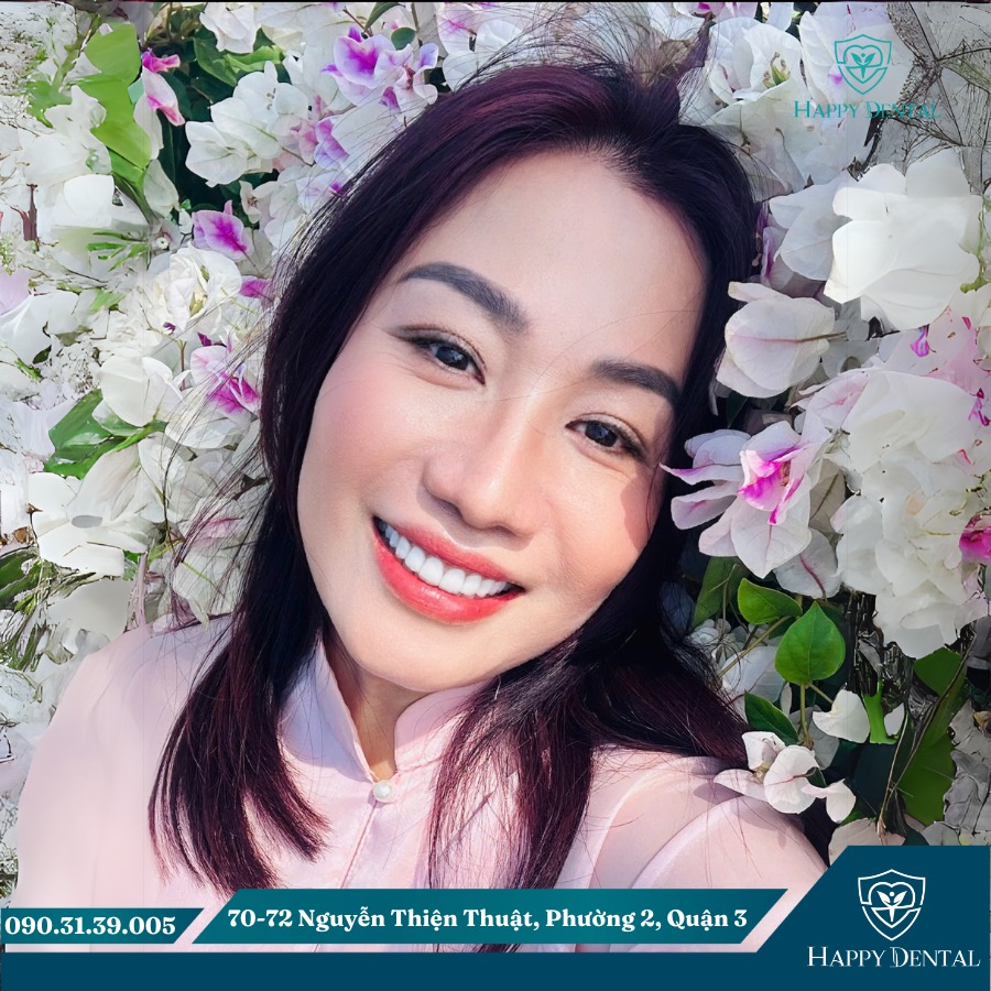 Kết quả sau điều trị cười hở lợi tại Happy Dental