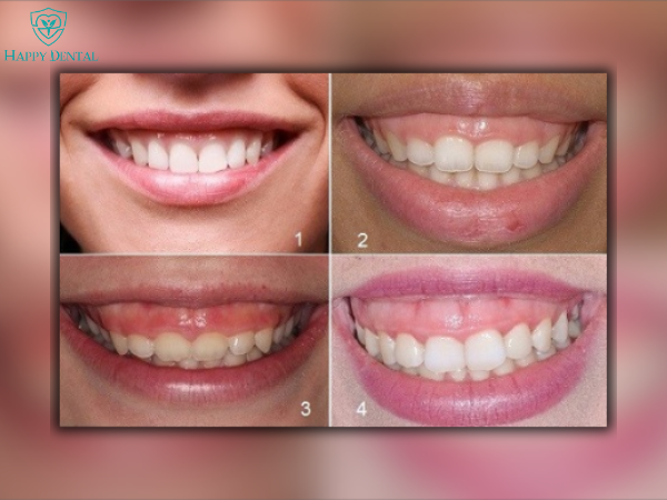 Mức độ cười hở lợi