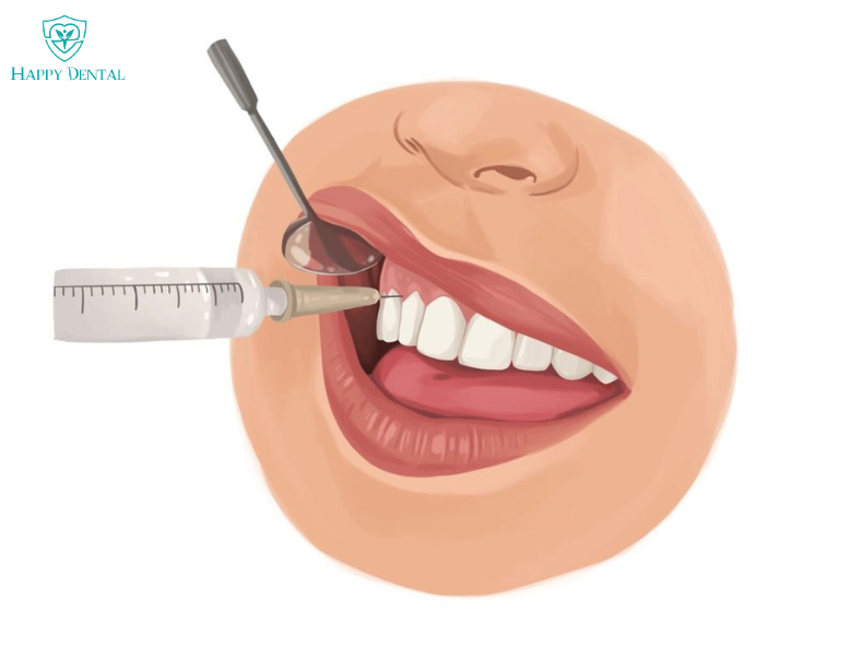 Các loại thuốc tê nha khoa