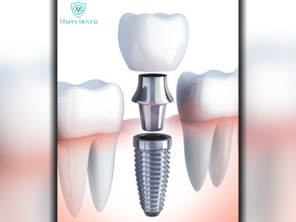 Cấy ghép Implant được xem là giải pháp tối ưu cho những ai bị mất răng