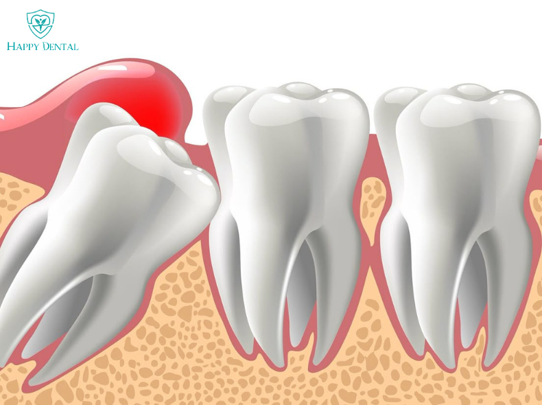 Nhức chân răng hàm dưới