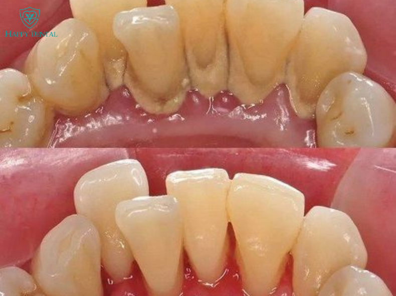 Nhức chân răng hàm dưới