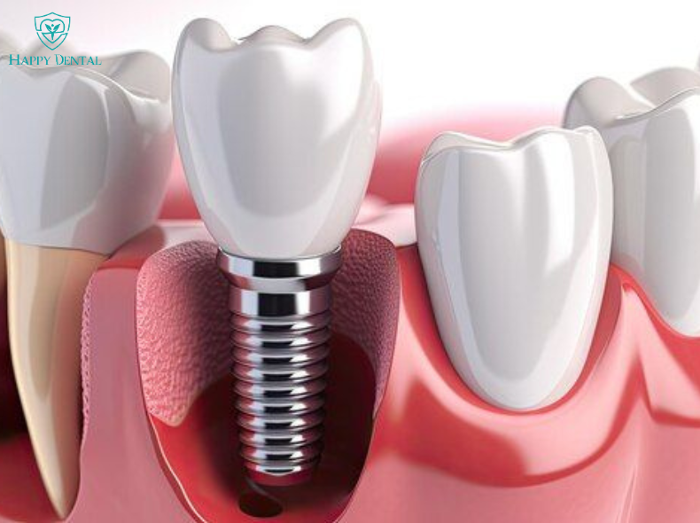 Trồng răng Implant