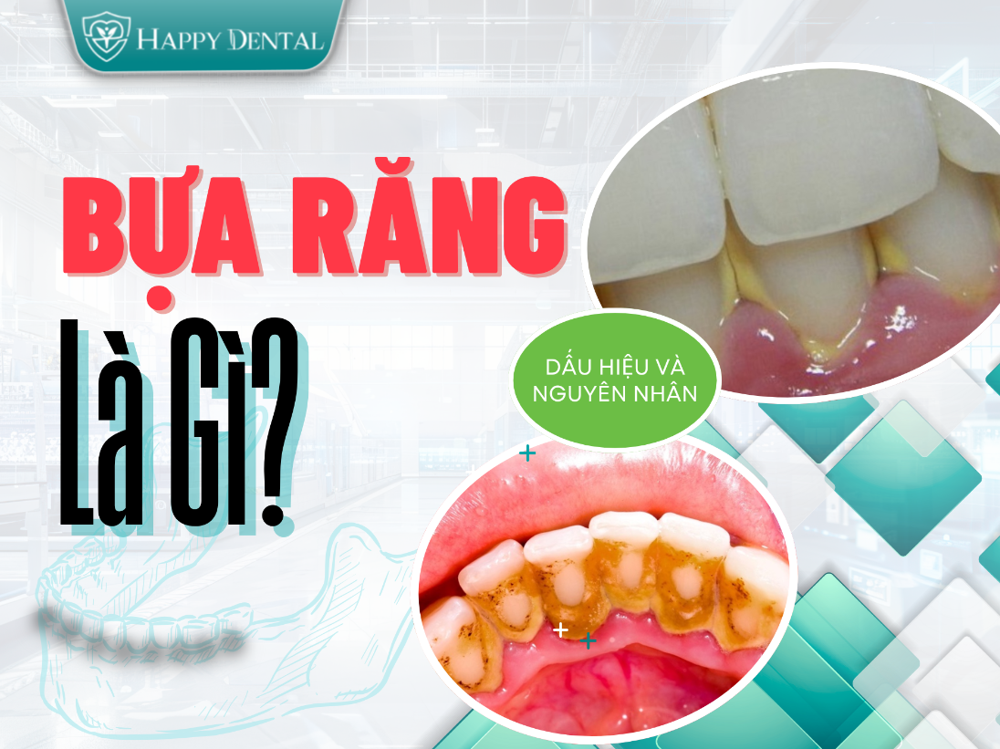 bua-rang-la-gi