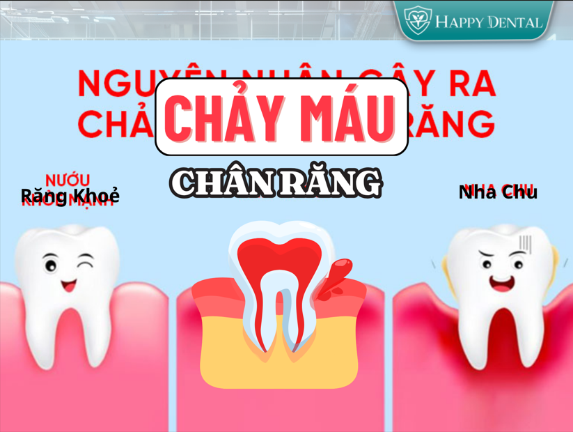 Chảy máu chân răng