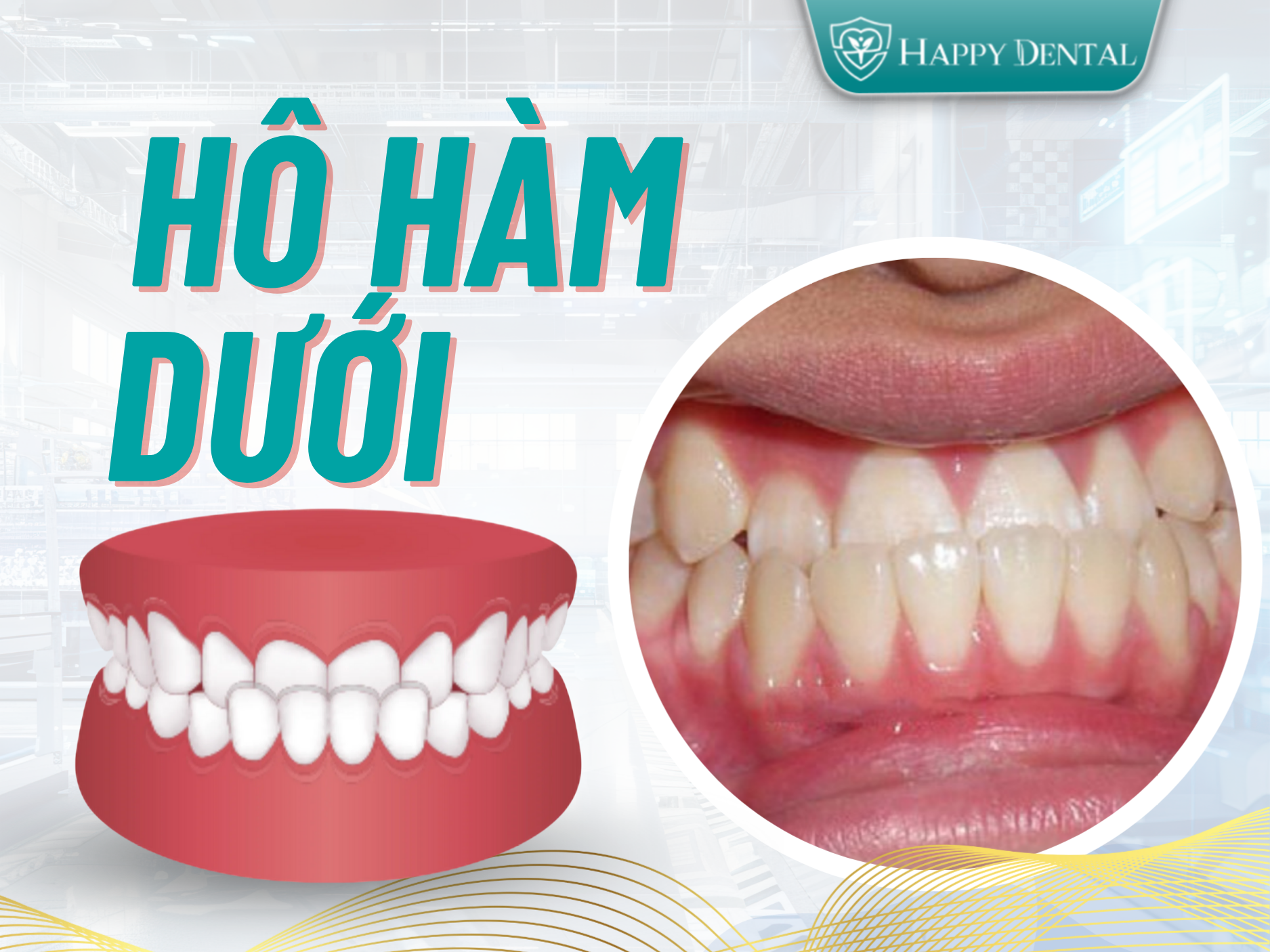 Hô hàm dưới