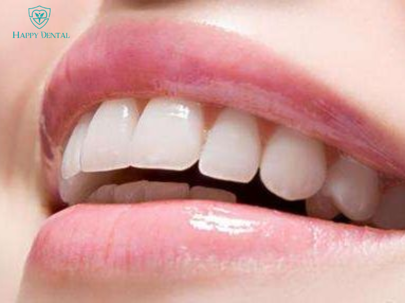 Răng sứ vĩnh viễn