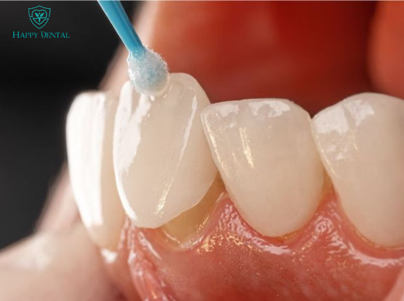 Răng sứ vĩnh viễn