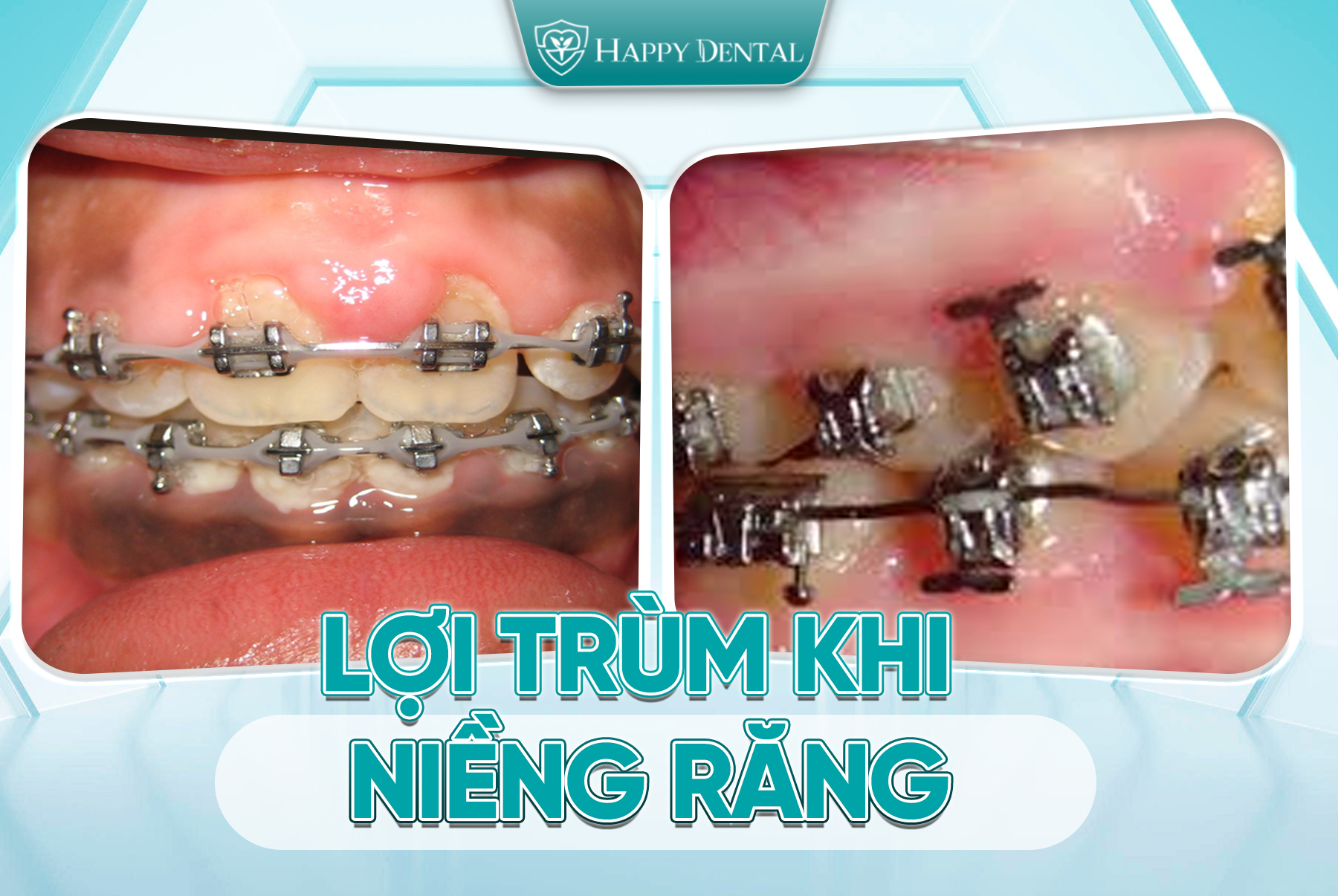 Lợi Trùm Khi Niềng Răng Là Gì? Nguyên Nhân Và Cách Xử Lý Lợi Trùm Khi Niềng Răng An Toàn 1 Lợi trùm khi niềng răng