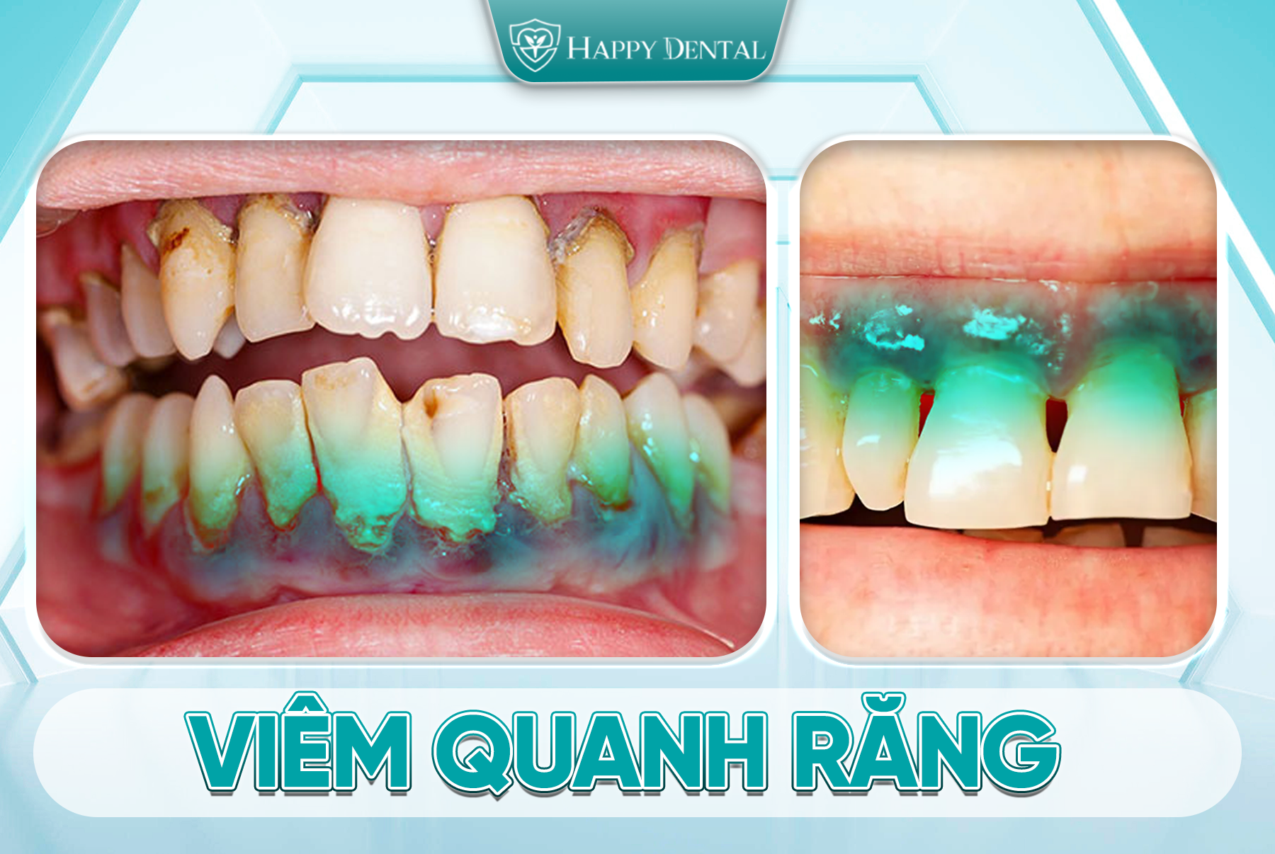 Viêm Quanh Răng Có Nguy Hiểm Không? Dấu Hiệu Và Cách Điều Trị 2 Viêm quanh răng